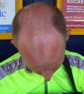 Cycling sunburn
