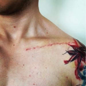 Collarbone scar