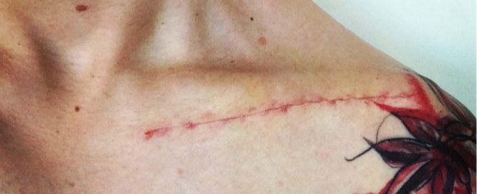 Collarbone scar